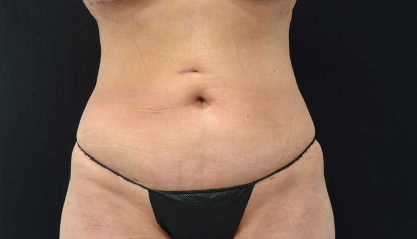 Liposuction