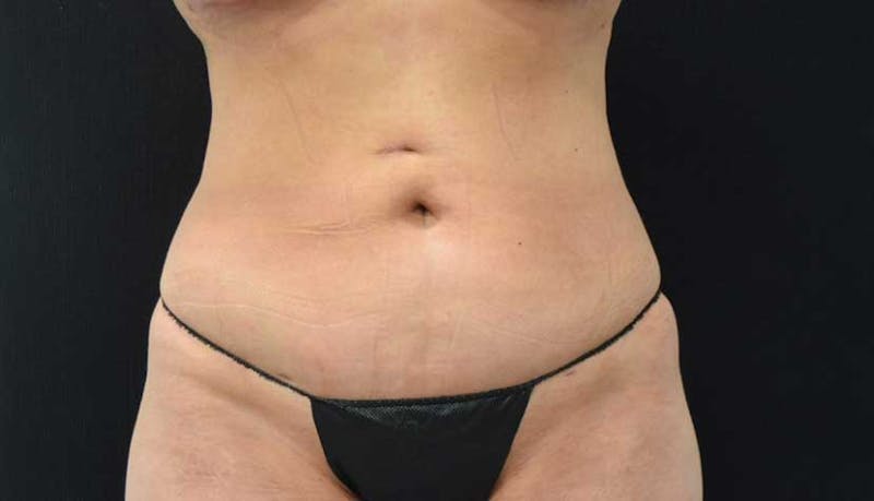 Liposuction Before & After Gallery - Patient 102564208 - Image 2