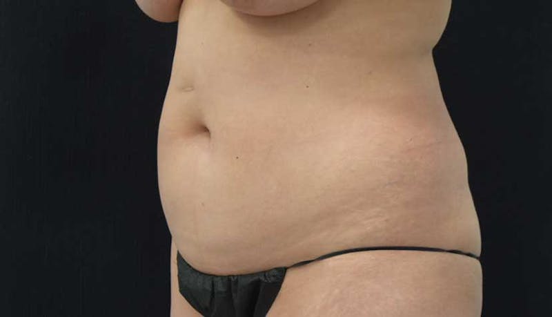 Liposuction Gallery - Patient 102564208 - Image 3
