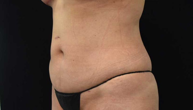 Liposuction Before & After Gallery - Patient 102564208 - Image 4