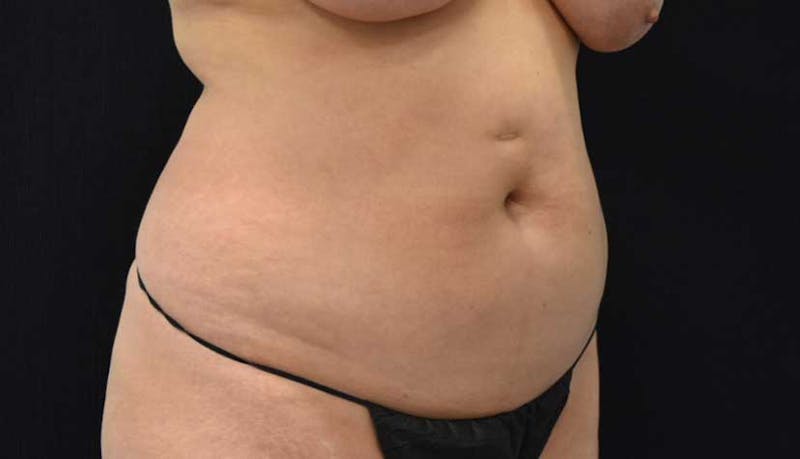 Liposuction Before & After Gallery - Patient 102564208 - Image 5