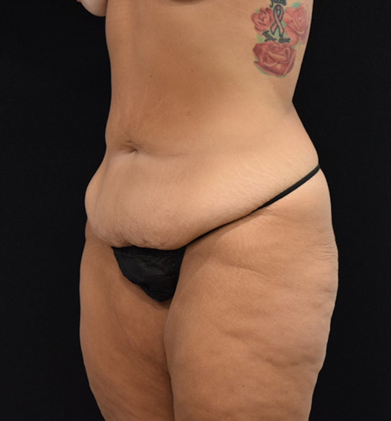 Fat Transfer to Buttock Before & After Gallery - Patient 102564213 - Image 3