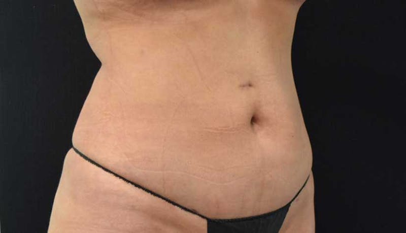 Liposuction Before & After Gallery - Patient 102564208 - Image 6