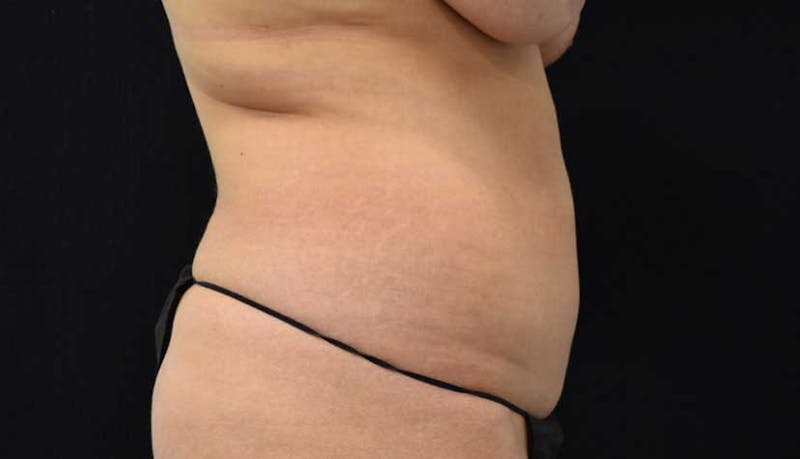 Liposuction Gallery - Patient 102564208 - Image 7