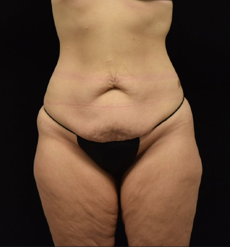 Lower Body Lift Gallery - Patient 102564215 - Image 1