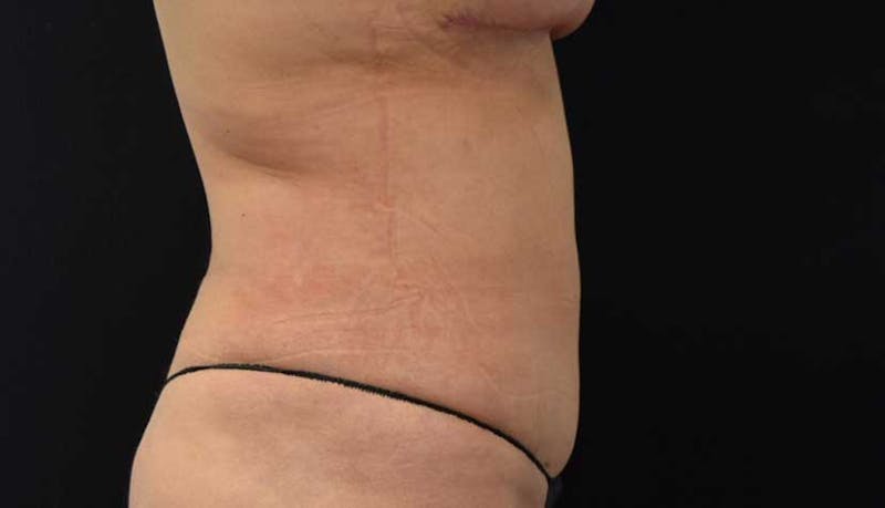 Liposuction Before & After Gallery - Patient 102564208 - Image 8