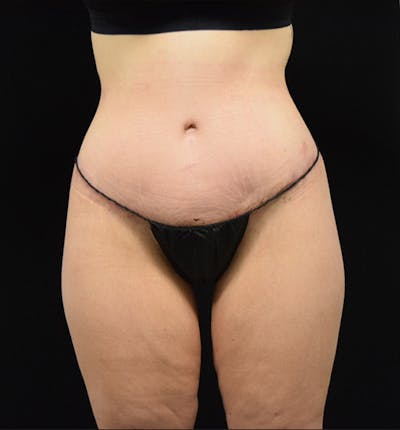 Lower Body Lift Before & After Gallery - Patient 102564215 - Image 2