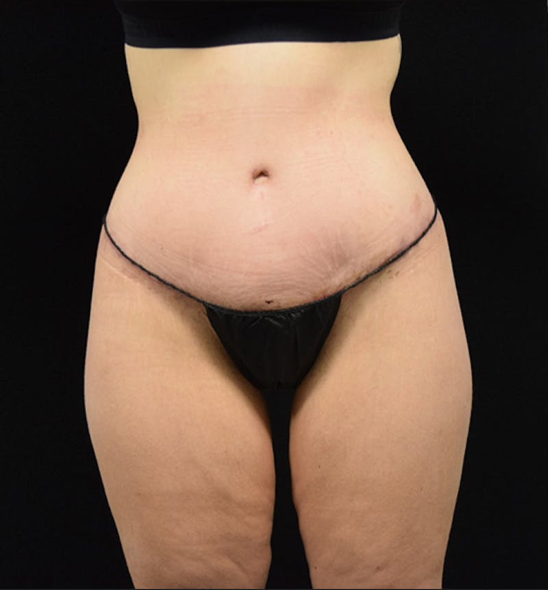 Lower Body Lift Before & After Gallery - Patient 102564215 - Image 2