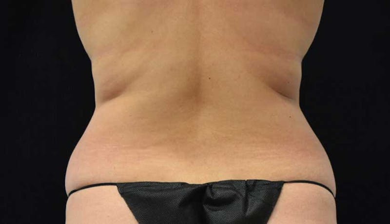 Liposuction Before & After Gallery - Patient 102564208 - Image 9