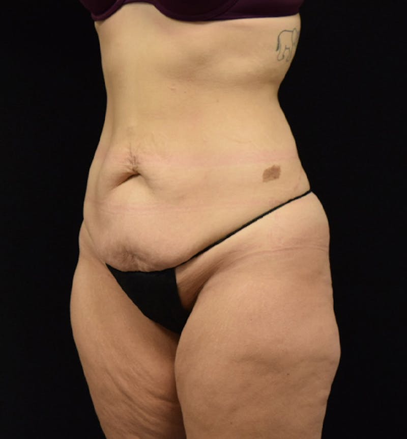 Lower Body Lift Before & After Gallery - Patient 102564215 - Image 3