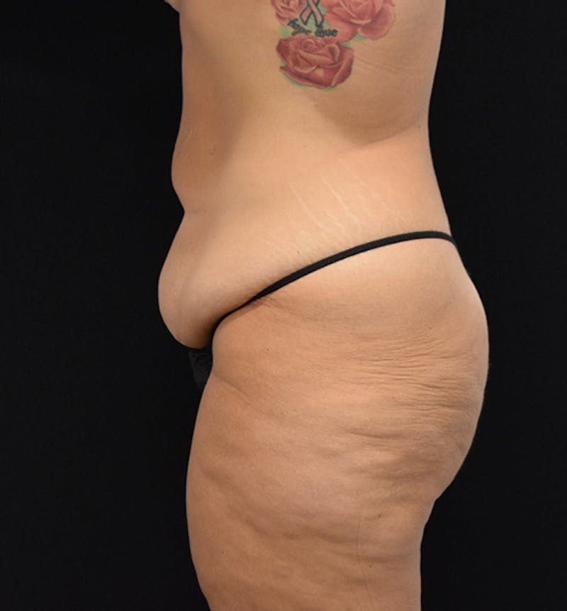 Fat Transfer to Buttock Before & After Gallery - Patient 102564213 - Image 5