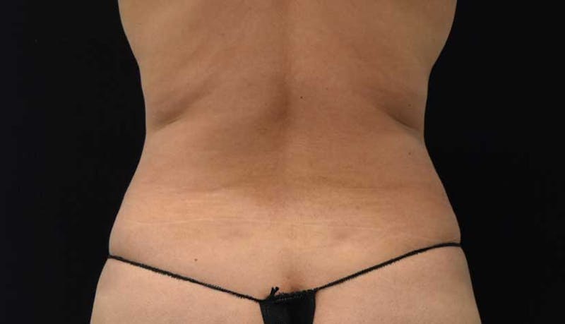 Liposuction Before & After Gallery - Patient 102564208 - Image 10
