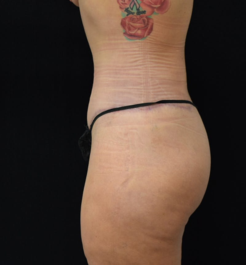 Fat Transfer to Buttock Before & After Gallery - Patient 102564213 - Image 6