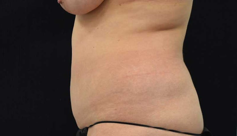 Liposuction Gallery - Patient 102564208 - Image 11