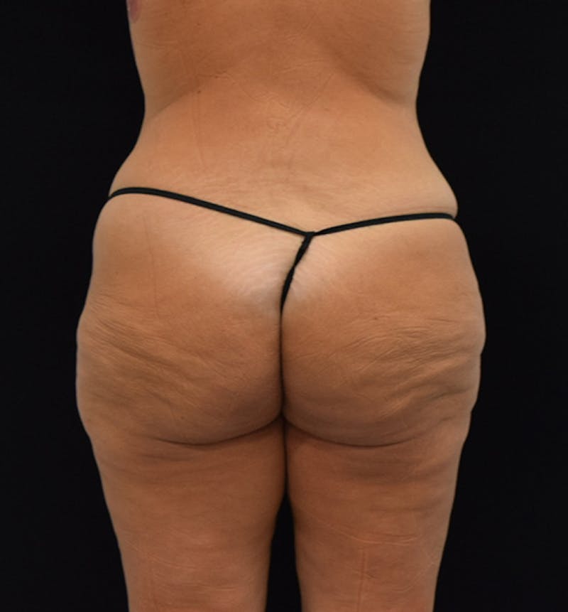 Fat Transfer to Buttock Before & After Gallery - Patient 102564213 - Image 7