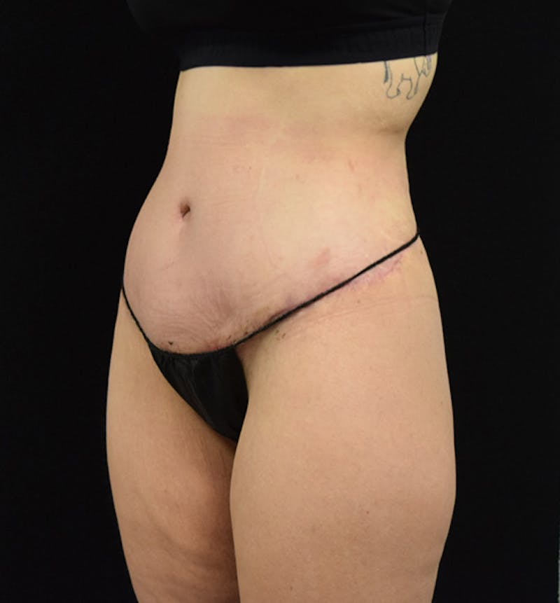 Lower Body Lift Gallery - Patient 102564215 - Image 4