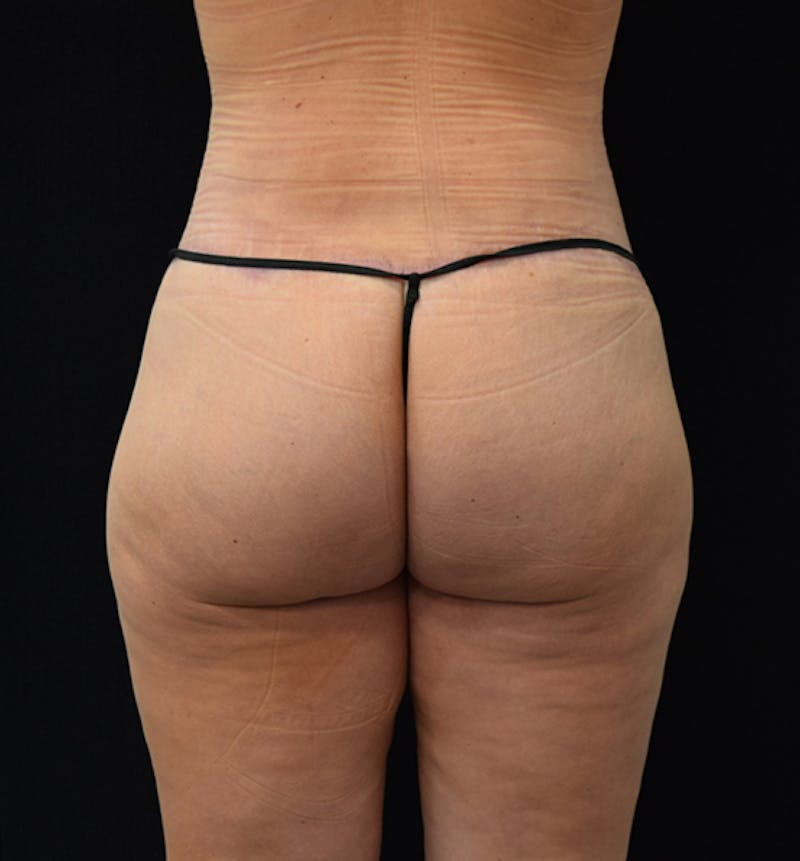Fat Transfer to Buttock Before & After Gallery - Patient 102564213 - Image 8