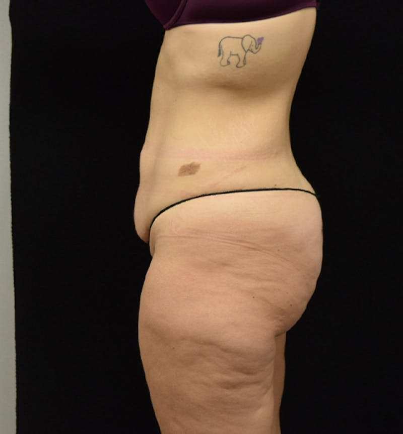 Lower Body Lift Before & After Gallery - Patient 102564215 - Image 5