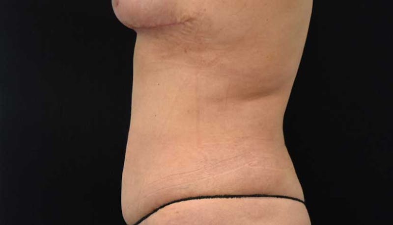 Liposuction Gallery - Patient 102564208 - Image 12