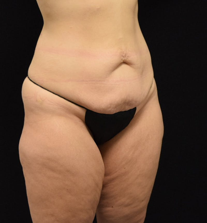 Lower Body Lift Before & After Gallery - Patient 102564215 - Image 7