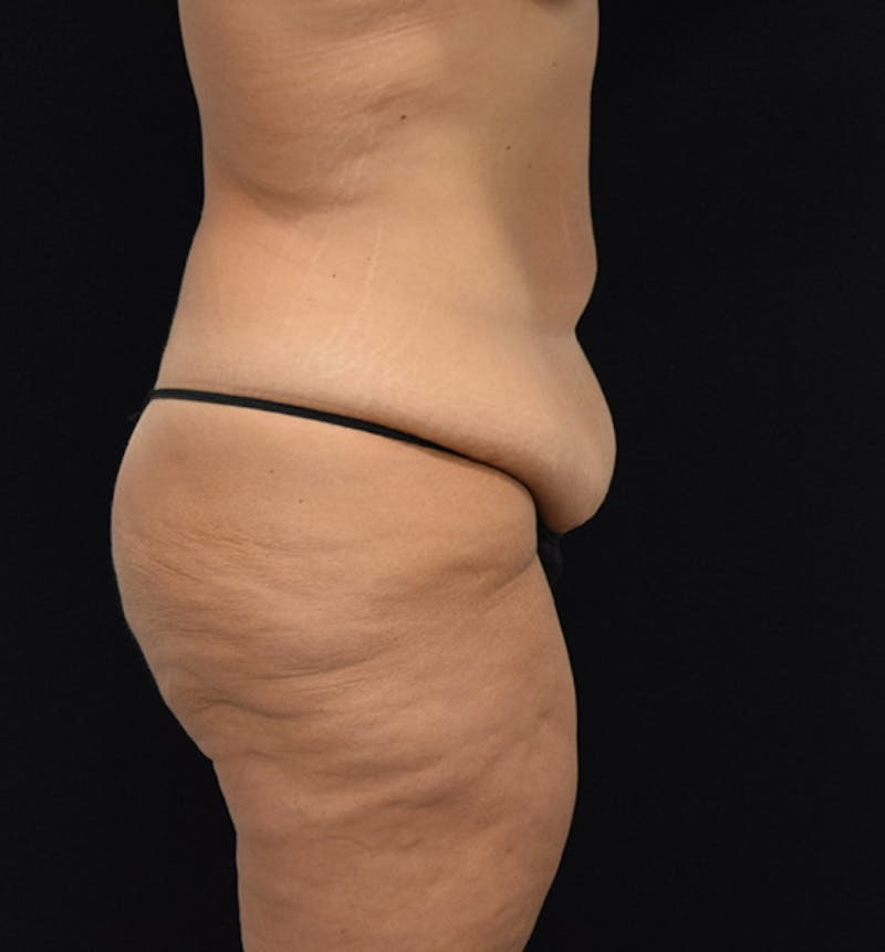 Fat Transfer to Buttock Before & After Gallery - Patient 102564213 - Image 9
