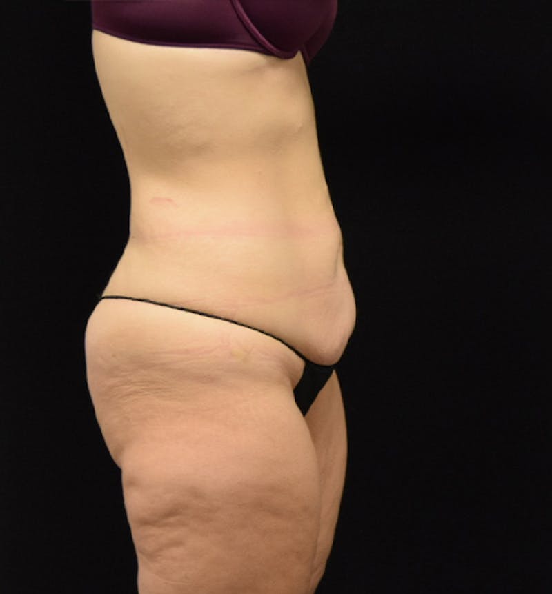 Lower Body Lift Before & After Gallery - Patient 102564215 - Image 9