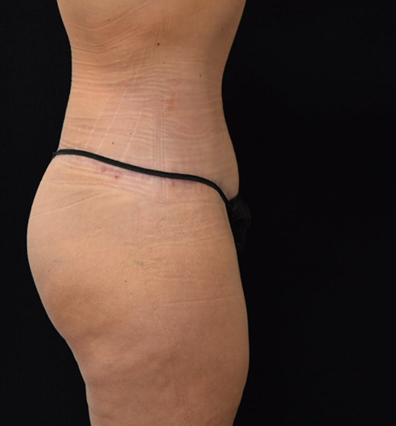 Fat Transfer to Buttock Before & After Gallery - Patient 102564213 - Image 10
