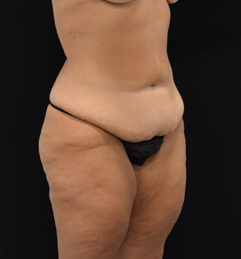 Fat Transfer to Buttock Before & After Gallery - Patient 102564213 - Image 11
