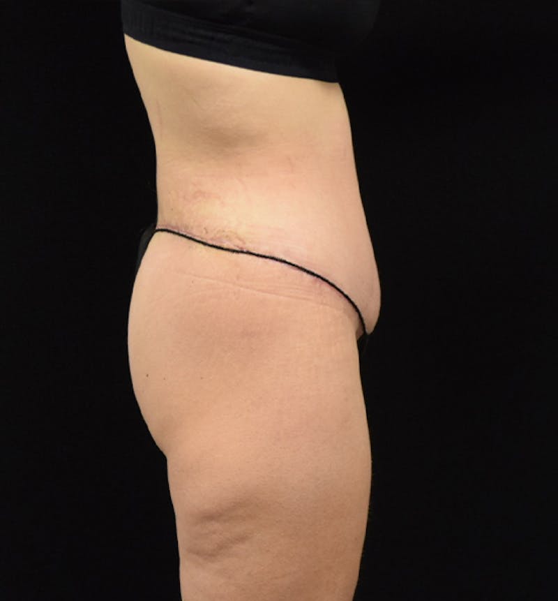 Lower Body Lift Before & After Gallery - Patient 102564215 - Image 10