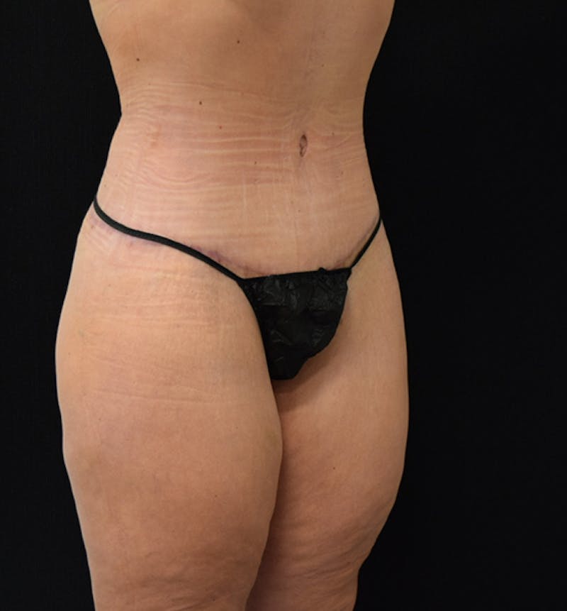 Fat Transfer to Buttock Before & After Gallery - Patient 102564213 - Image 12