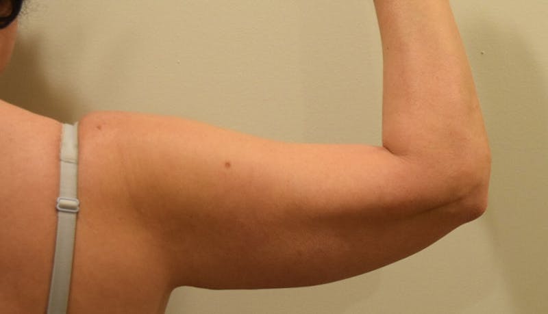 Liposuction Before & After Gallery - Patient 102564233 - Image 7