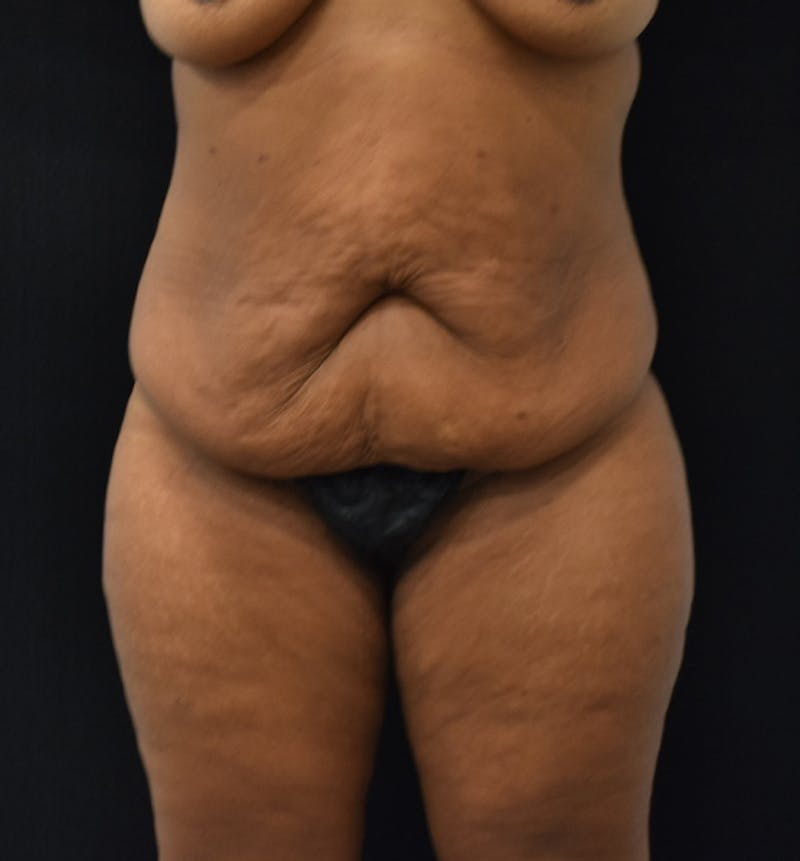 Fat Transfer to Buttock Before & After Gallery - Patient 102564237 - Image 1