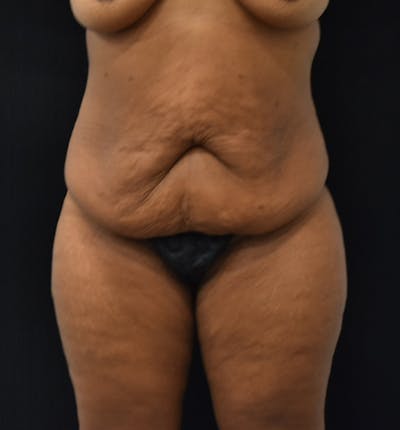 Fat Transfer Before & After Gallery - Patient 102564237 - Image 1