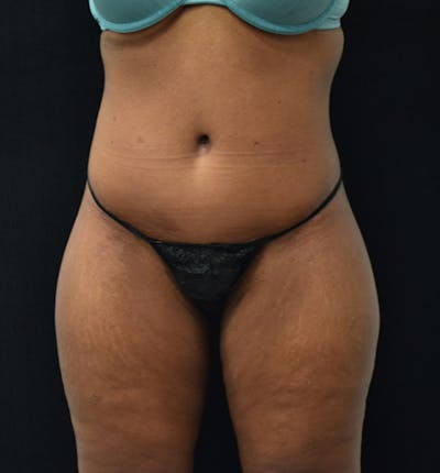 Fat Transfer to Buttock Before & After Gallery - Patient 102564237 - Image 2
