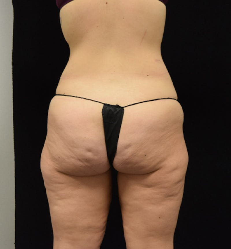 Lower Body Lift Before & After Gallery - Patient 102564215 - Image 12