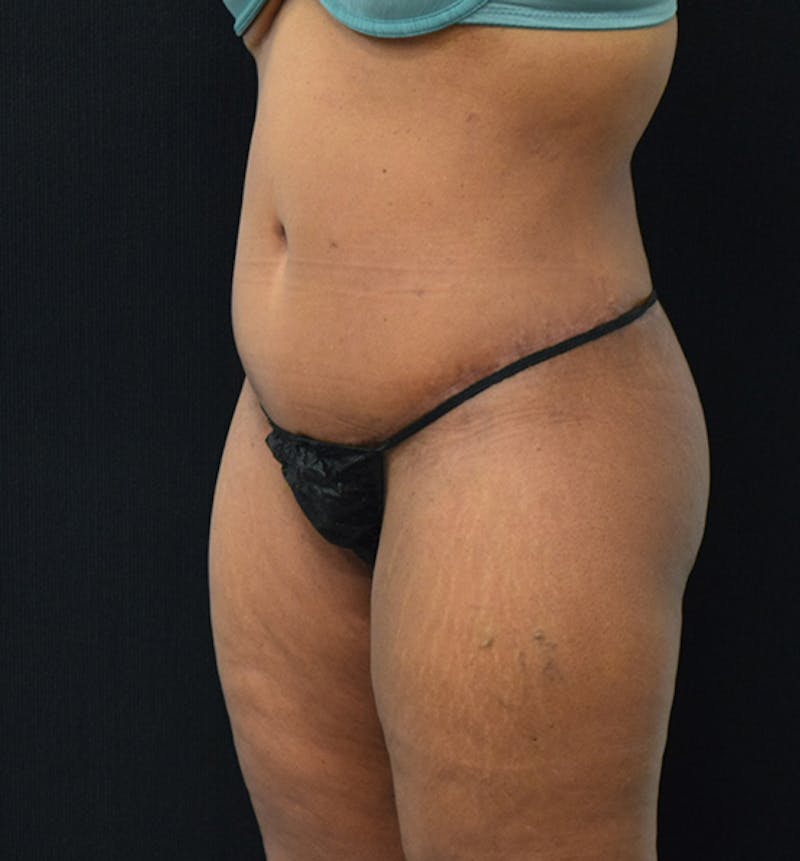 Fat Transfer to Buttock Before & After Gallery - Patient 102564237 - Image 4