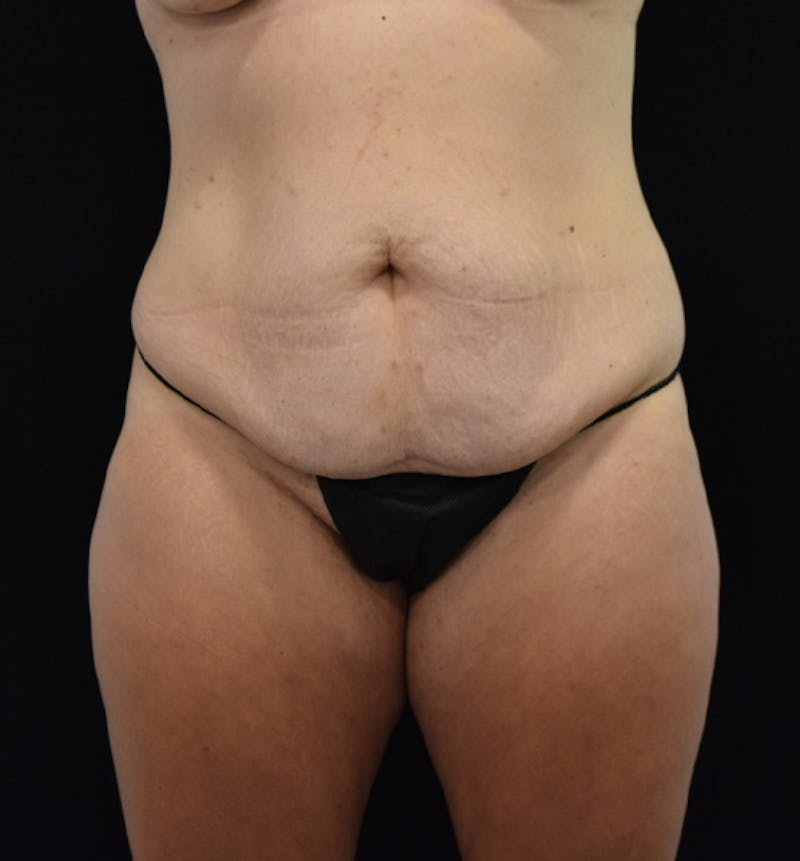 Lower Body Lift Before & After Gallery - Patient 102564241 - Image 1