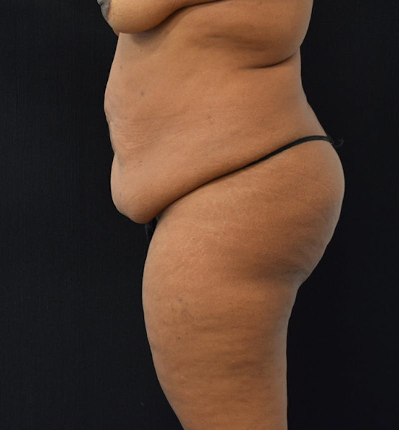 Fat Transfer Before & After Gallery - Patient 102564237 - Image 5