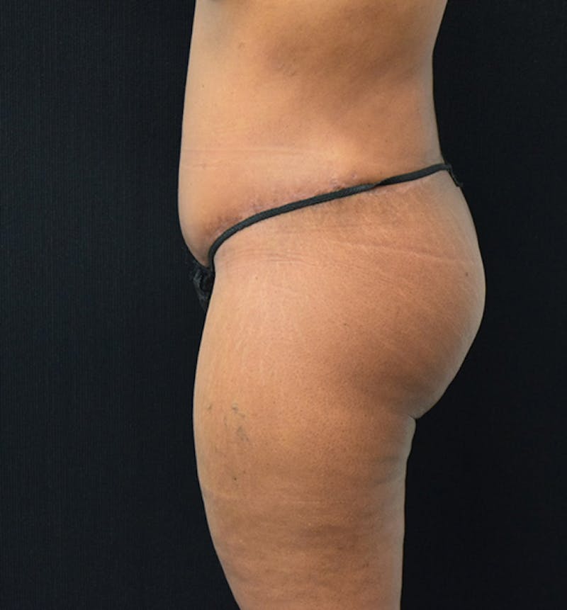 Fat Transfer to Buttock Before & After Gallery - Patient 102564237 - Image 6