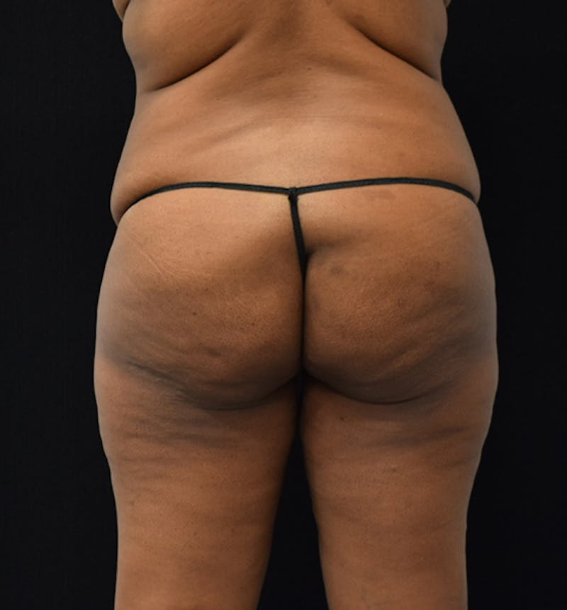 Fat Transfer to Buttock Before & After Gallery - Patient 102564237 - Image 7