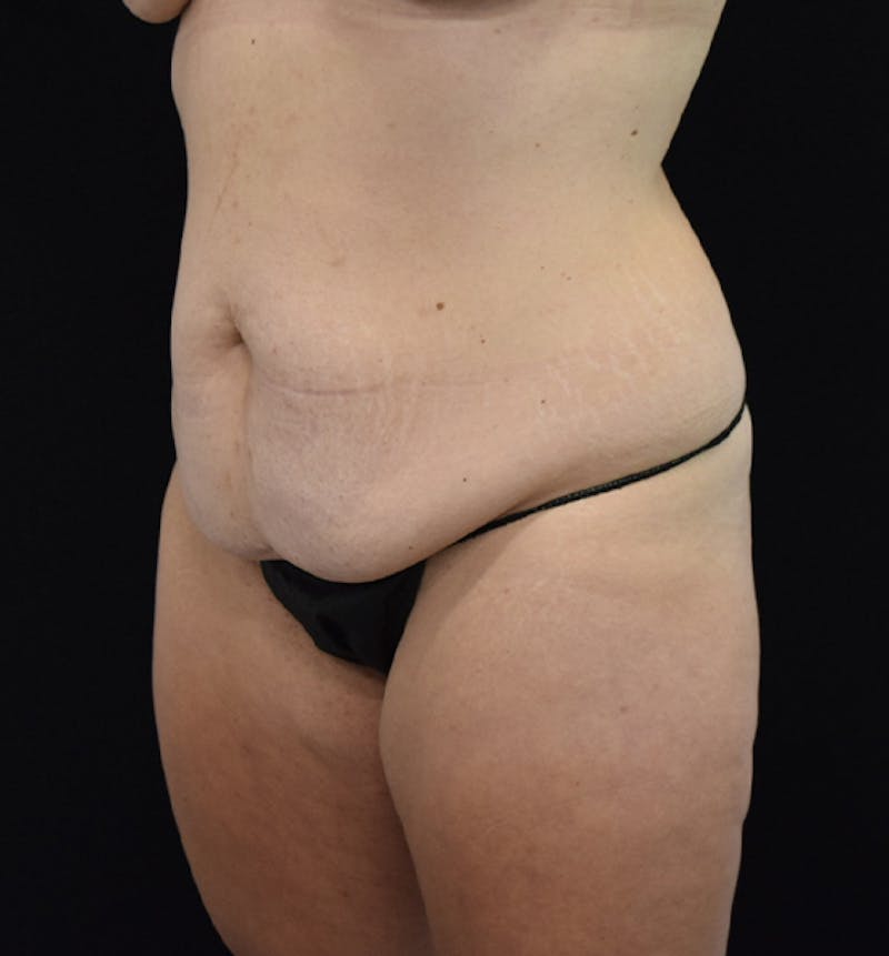 Lower Body Lift Before & After Gallery - Patient 102564241 - Image 3