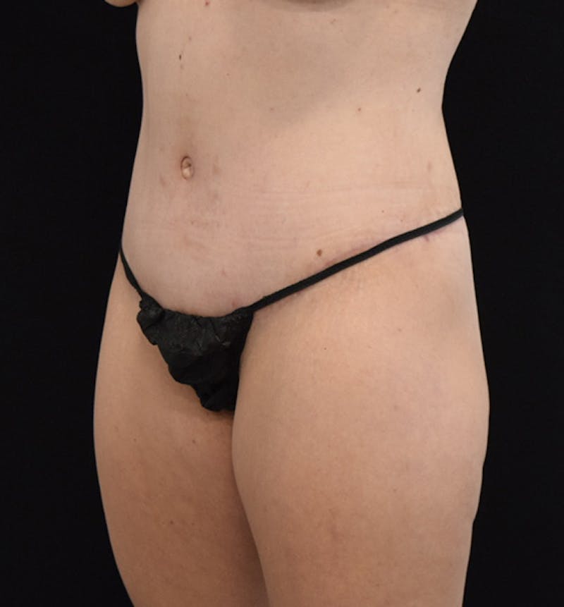Lower Body Lift Before & After Gallery - Patient 102564241 - Image 4