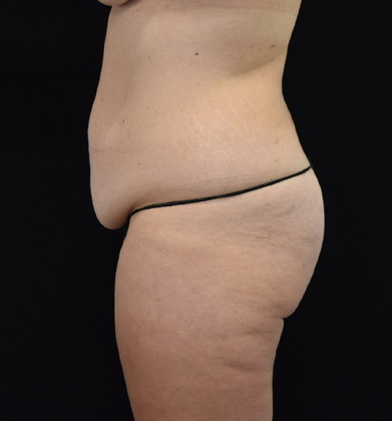 Lower Body Lift Before & After Gallery - Patient 102564241 - Image 5