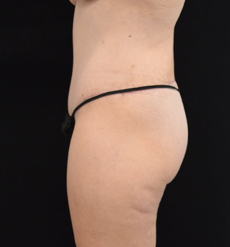 Lower Body Lift Before & After Gallery - Patient 102564241 - Image 6