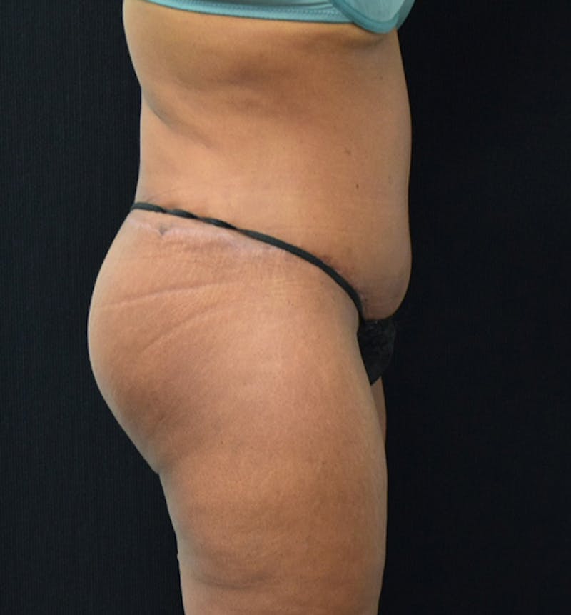 Fat Transfer to Buttock Before & After Gallery - Patient 102564237 - Image 10