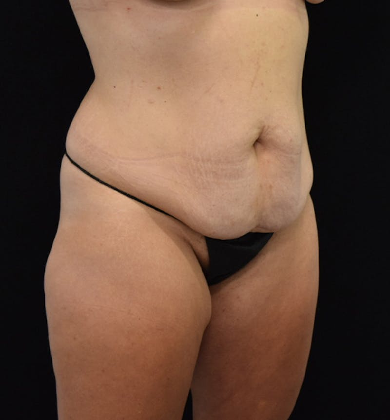 Lower Body Lift Before & After Gallery - Patient 102564241 - Image 7