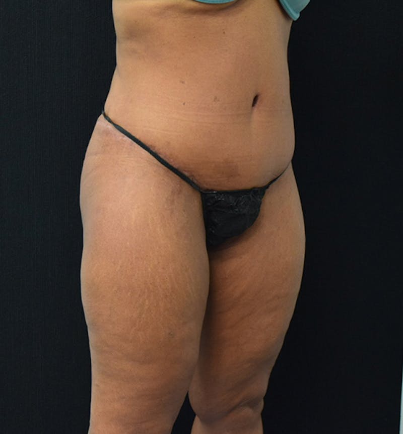 Fat Transfer to Buttock Before & After Gallery - Patient 102564237 - Image 12