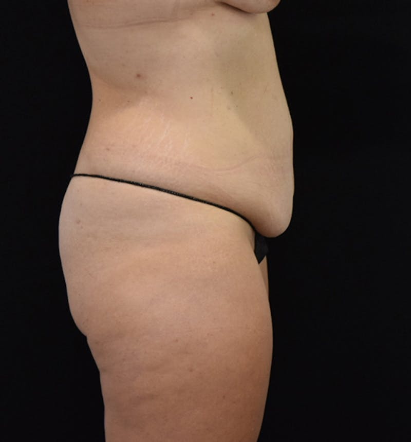 Lower Body Lift Before & After Gallery - Patient 102564241 - Image 9