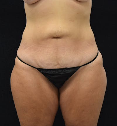 Fat Transfer to Buttock Before & After Gallery - Patient 102564242 - Image 1
