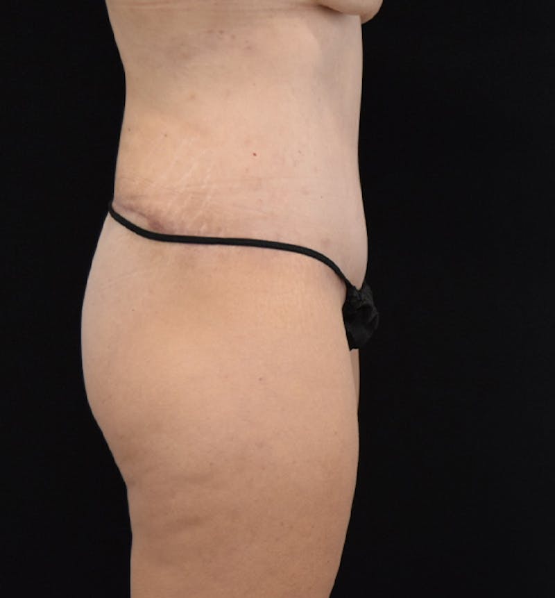 Lower Body Lift Before & After Gallery - Patient 102564241 - Image 10